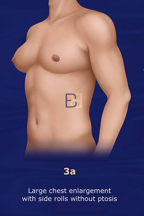 Grade 3a Enlargement Without Significant Ptosis