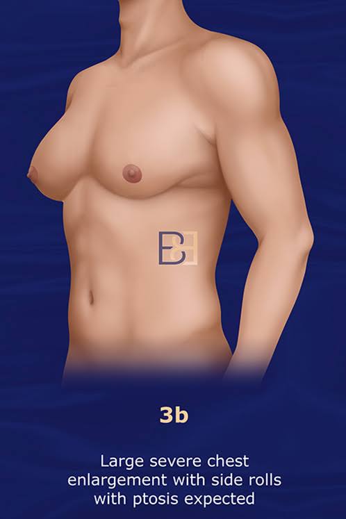 Grade 3b: Moderate Enlargement With Significant Ptosis