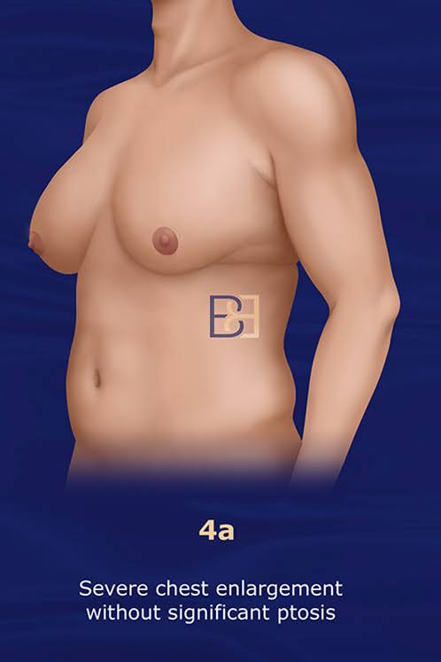 Grade 4a: Marked Enlargement With Significant Skin Excess and Ptosis