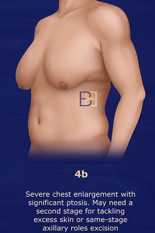 Grade 4b: Marked Enlargement With Significant Skin Excess and Ptosis