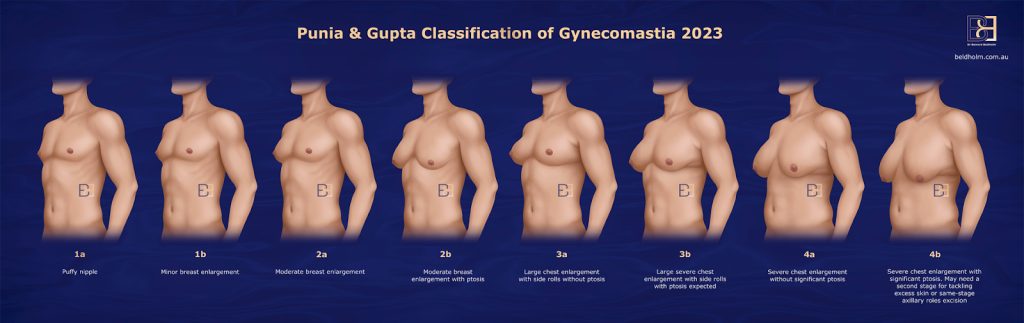 Punia and Gupta Classification (2023)