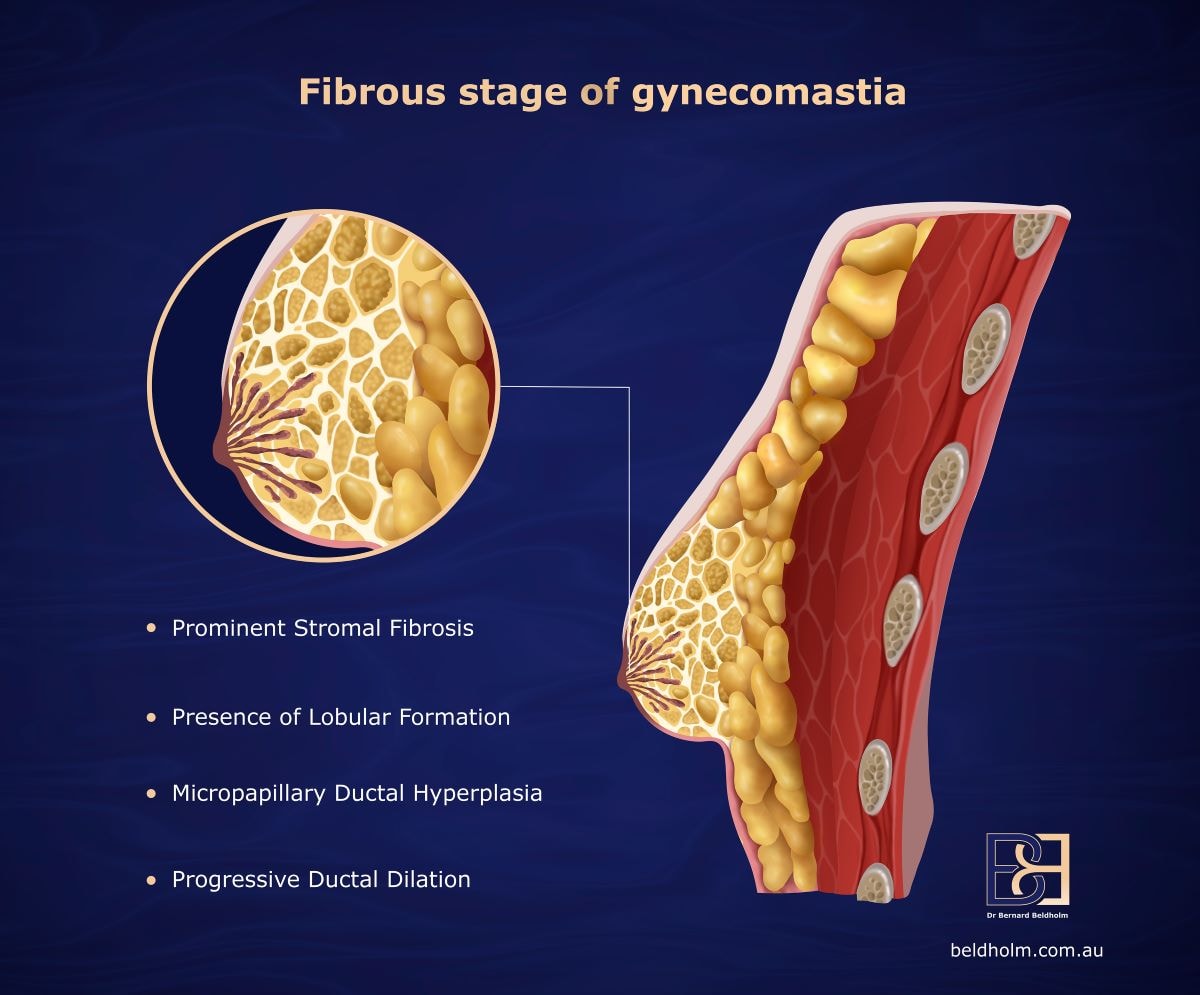 Fibrous stage of gynaecomastia | Dr Beldholm