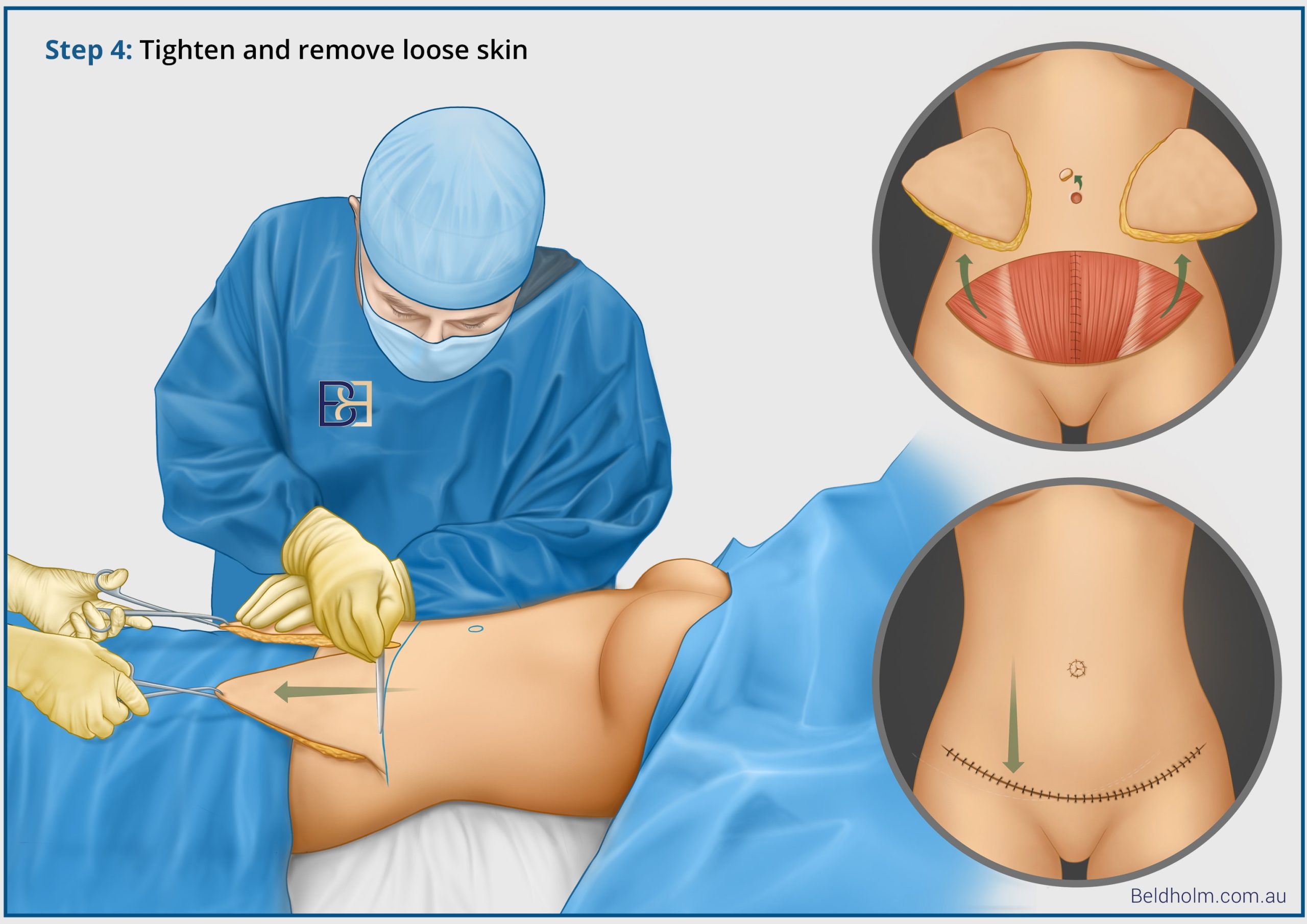 private health insurance cover for abdominoplasty surgery