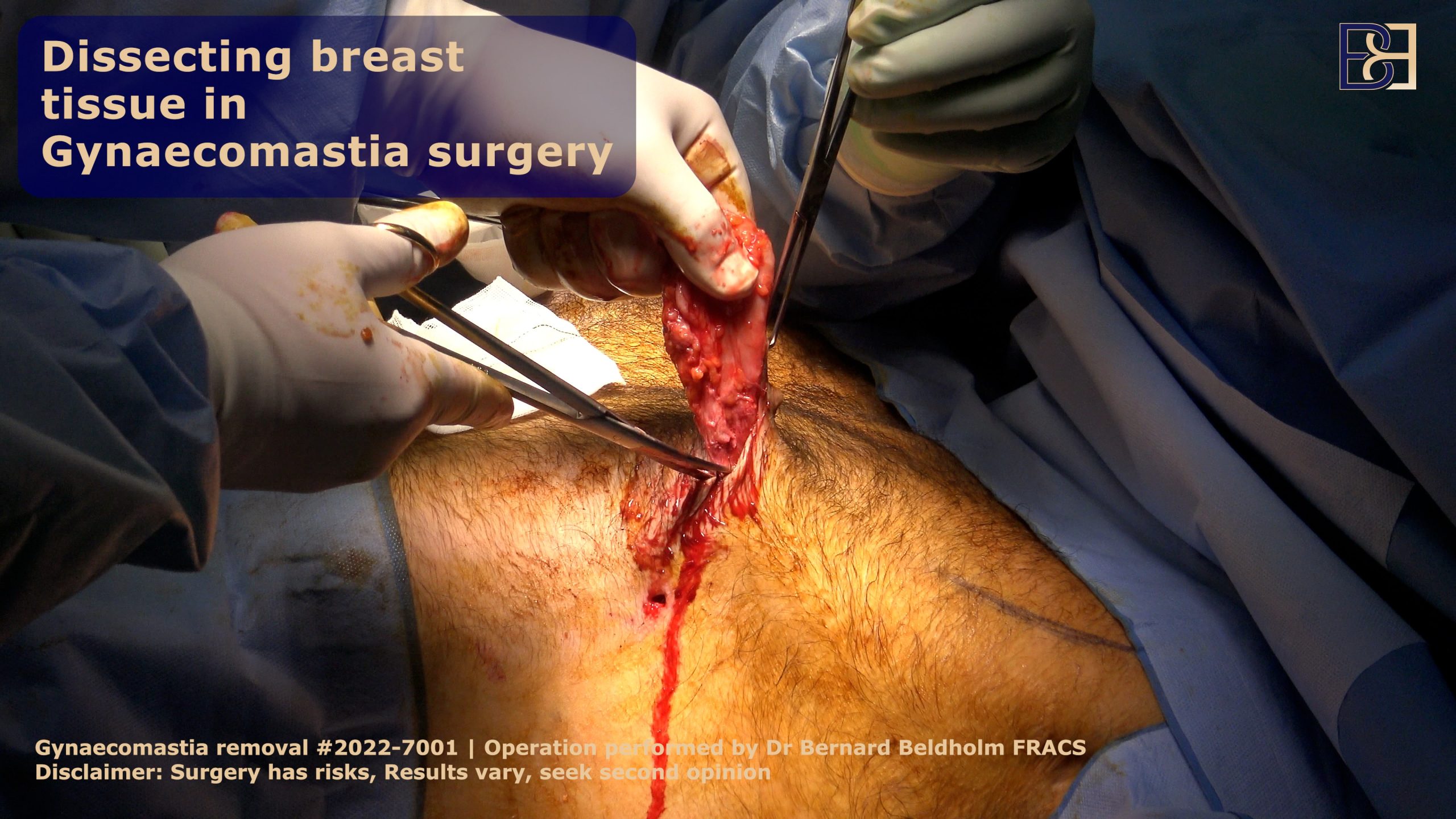 Illustration depicting subcutaneous mastectomy for gynaecomastia, a surgical treatment for male breast reduction.