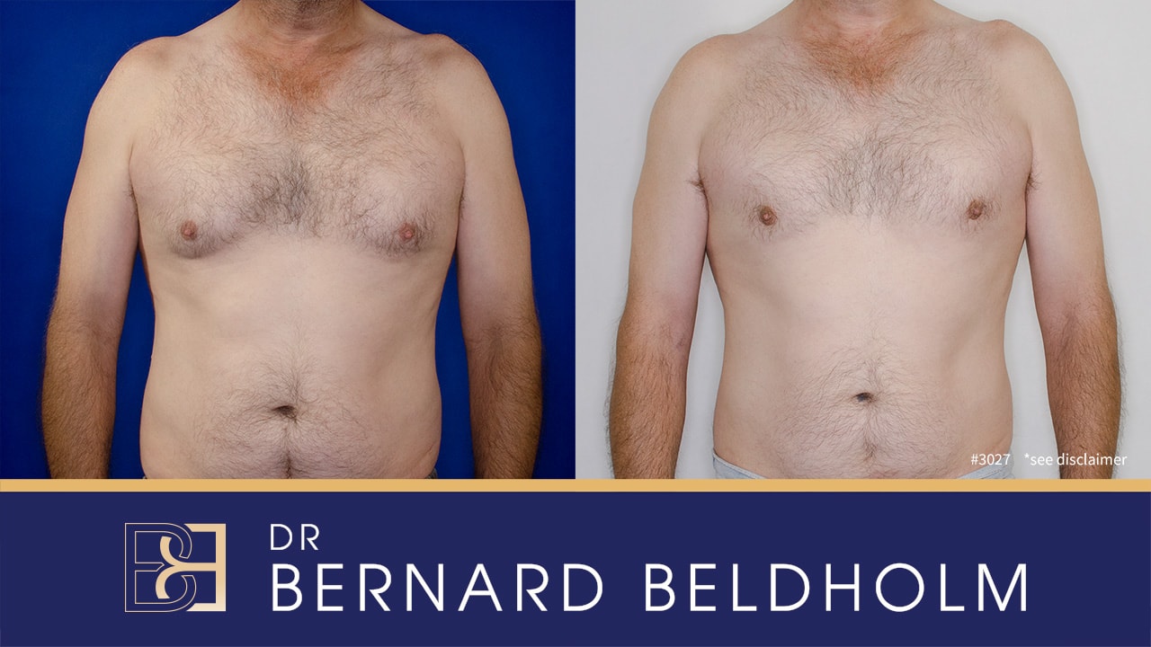 Before and after images of Gynaecomstia surgery | Dr Bernard Beldholm