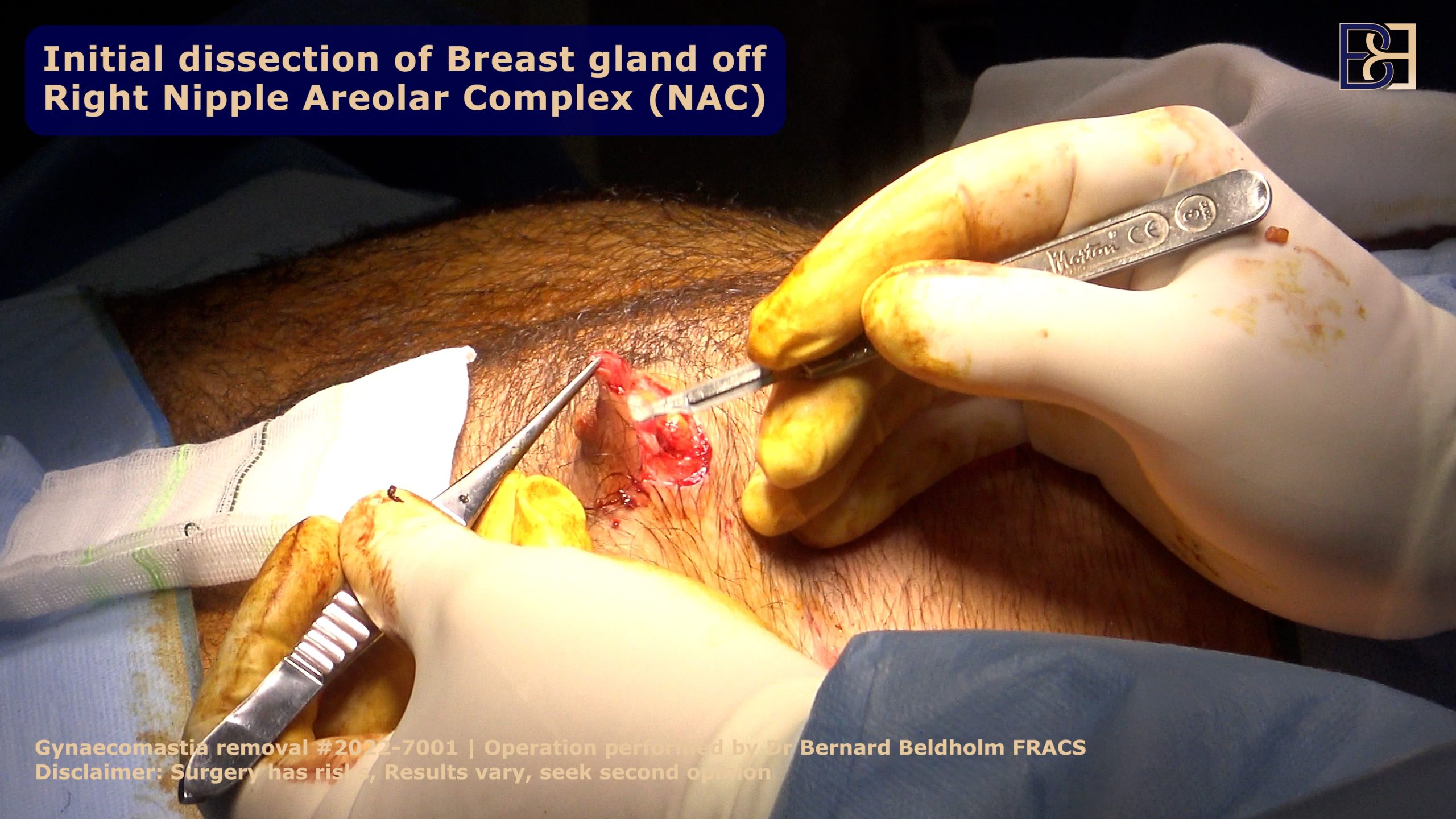 A cartoon depicting a surgeon performing endoscopic subcutaneous mastectomy.