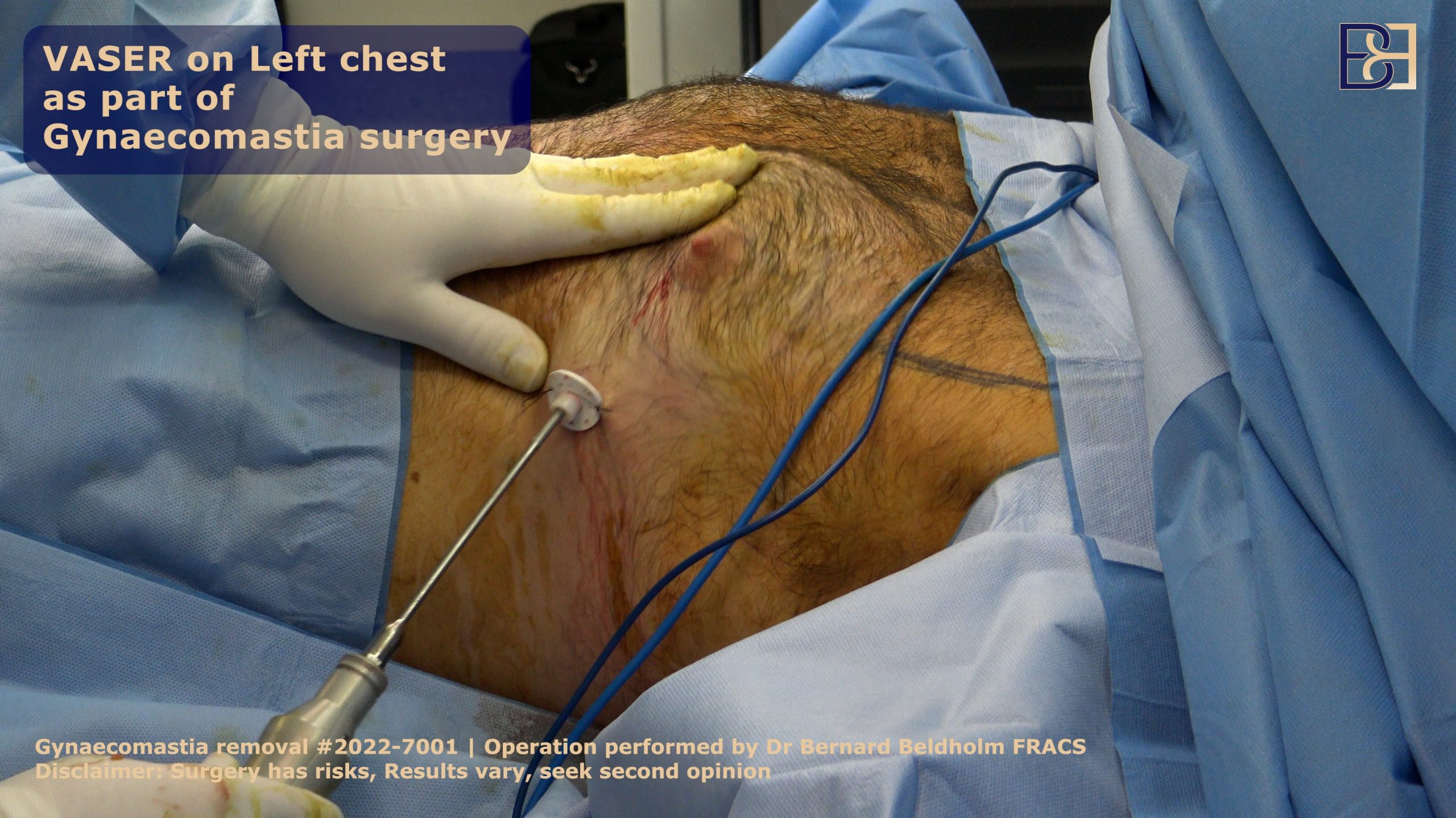 VASER liposuction as part of Gynaecoamstia surgery | Dr Beldholm