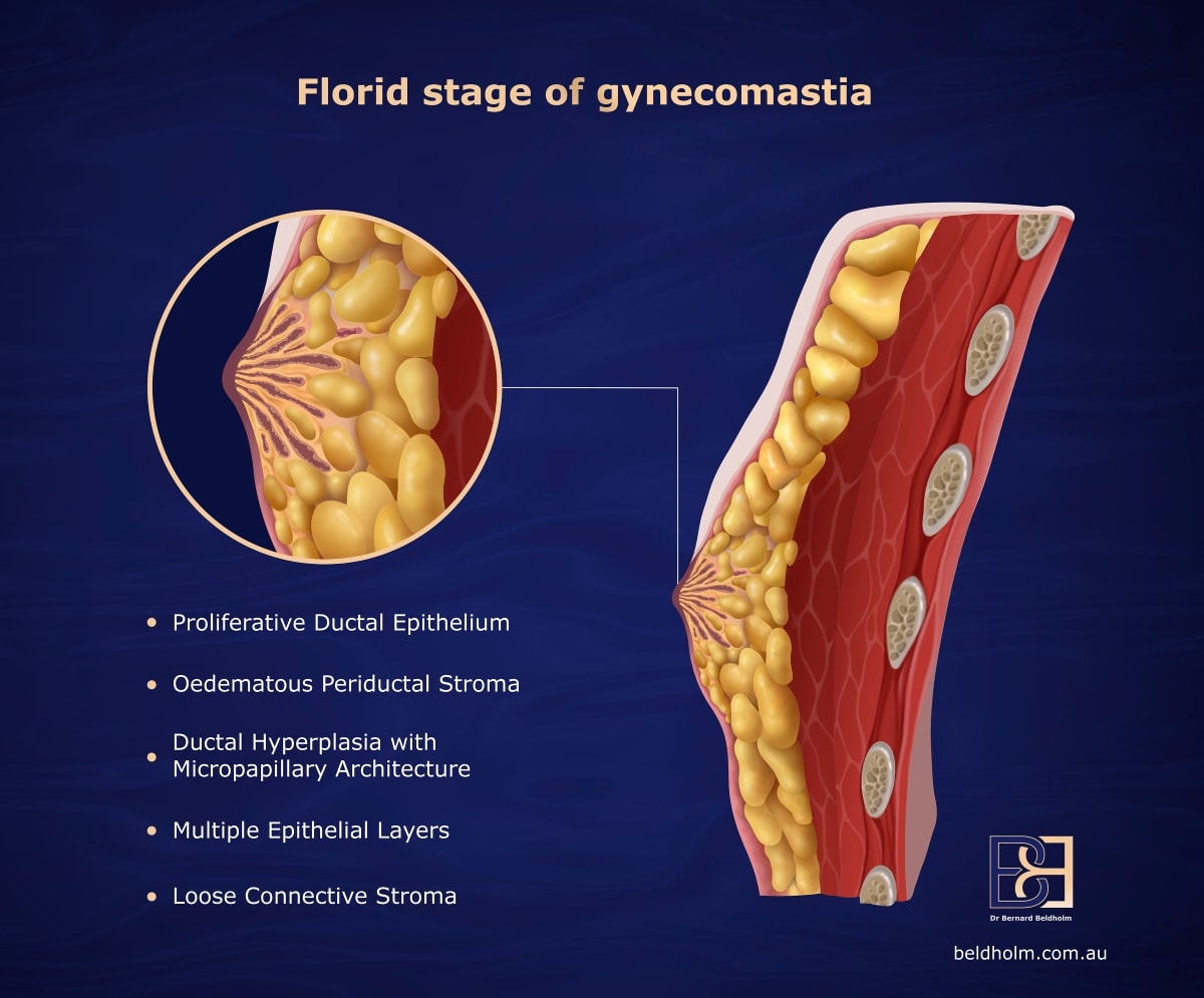 An illustration depicting the male breast anatomy affected by gynecomastia.