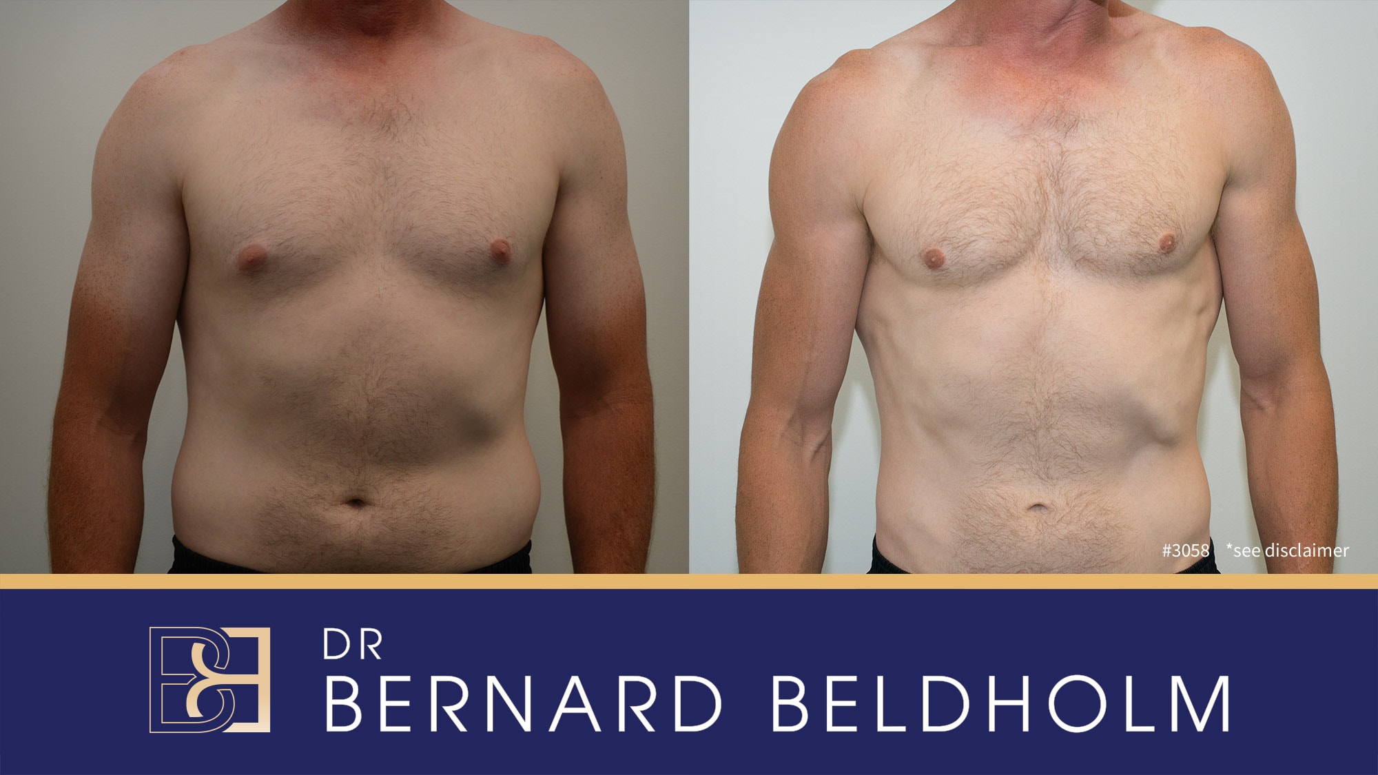 BB grade 2a gynaecomastia treated with Subcutanous mastecomy and VASER liposuction | Dr Beldholm