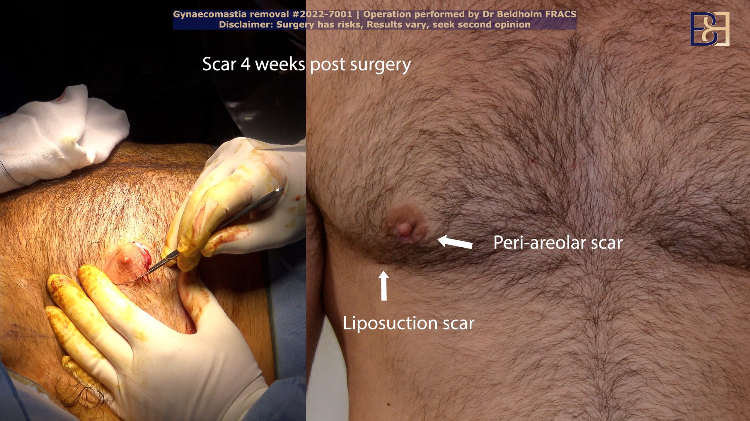 4 weeks post surgery, showing scar formation | Dr Bernard Beldholm