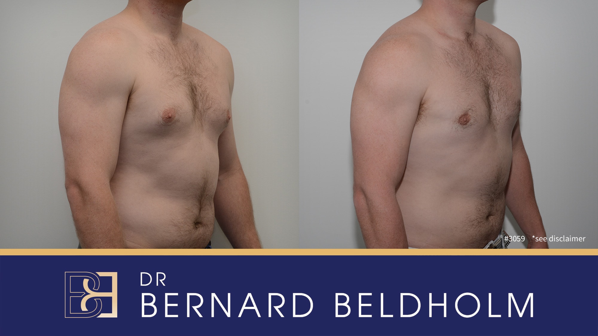 Gynaecomastia Before & After | Dr Bernard Beldholm