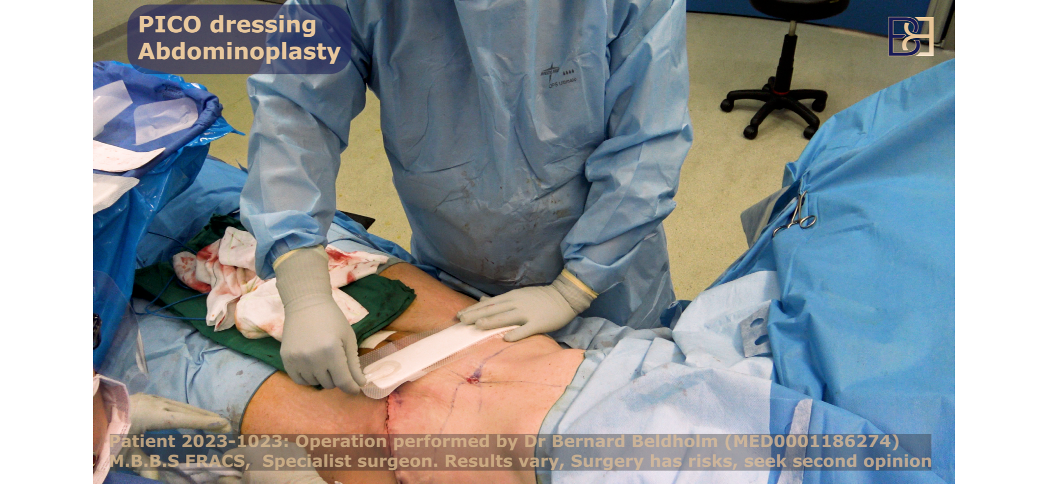 PICO Dressing to prevent wound infection following extended tummy tuck surgery