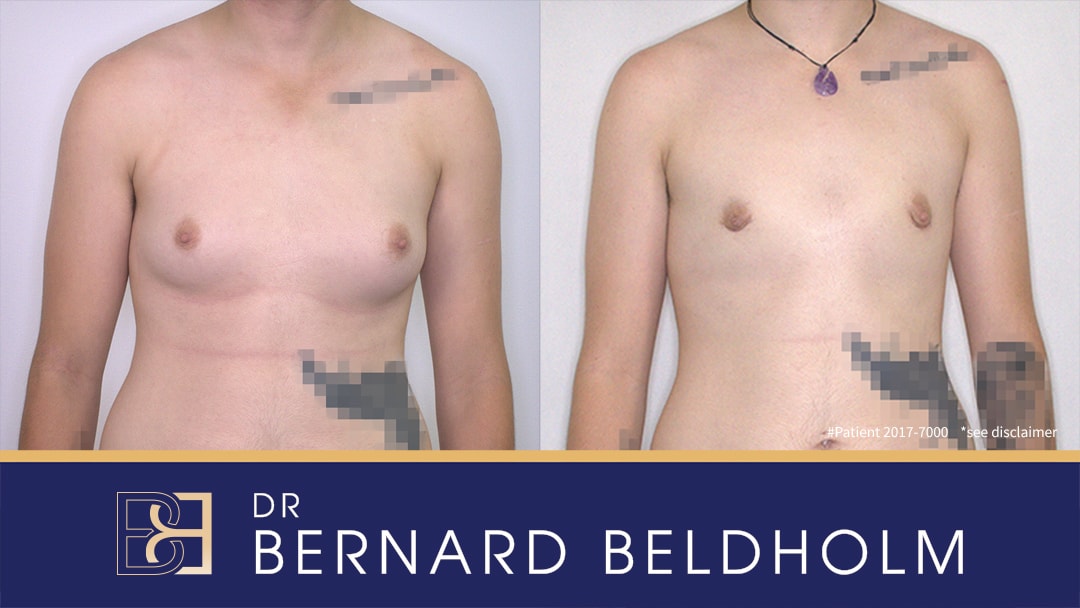 scar after sub-cutanous breast gland removal | Dr Bernard Beldholm