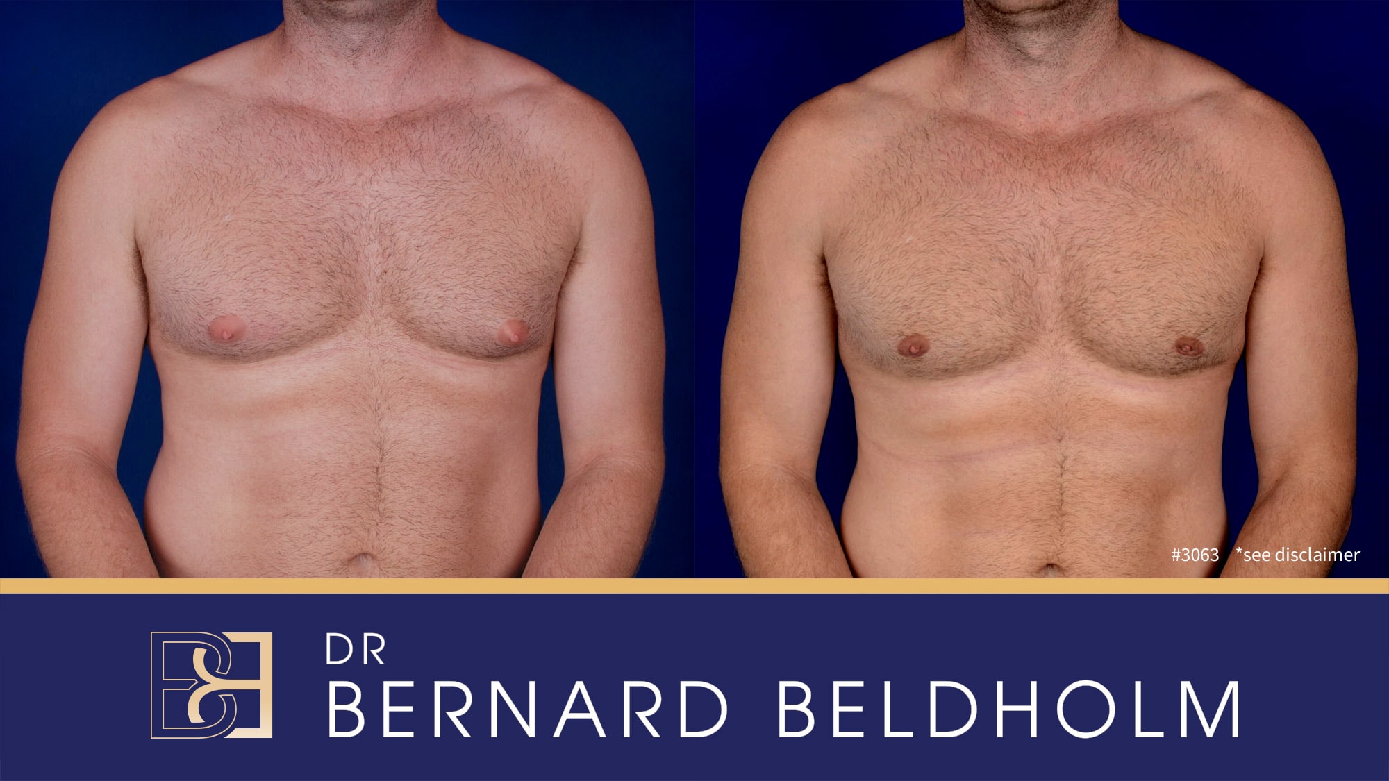 Gynaecoamstia surgery before & After | Dr Bernard Beldholm