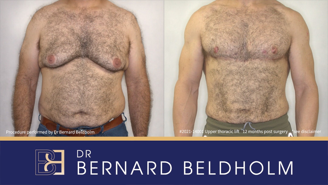 Torsoplasty Before & After 12 months post surgery| Dr Bernard Beldholm