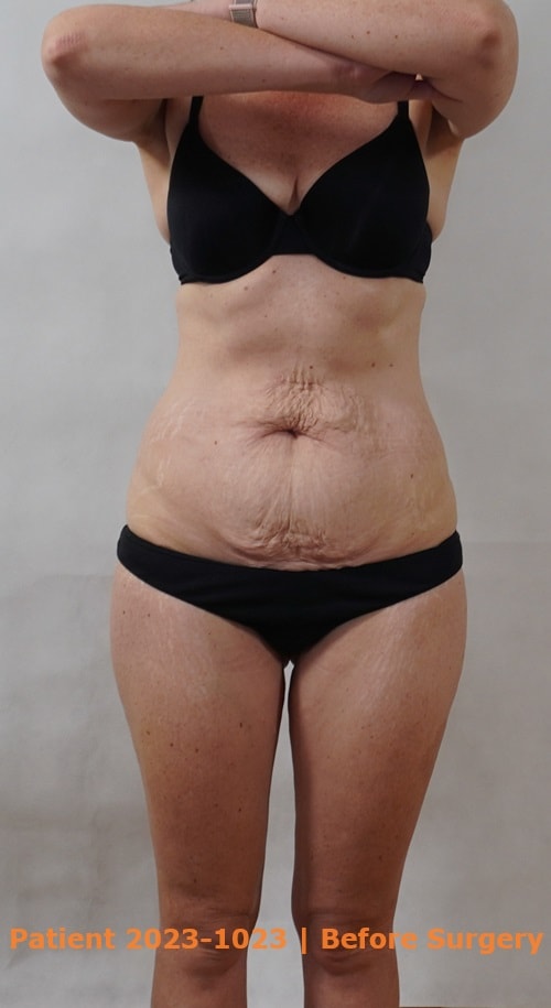 Before extended tummy tuck surgery | Dr Bernard Beldholm