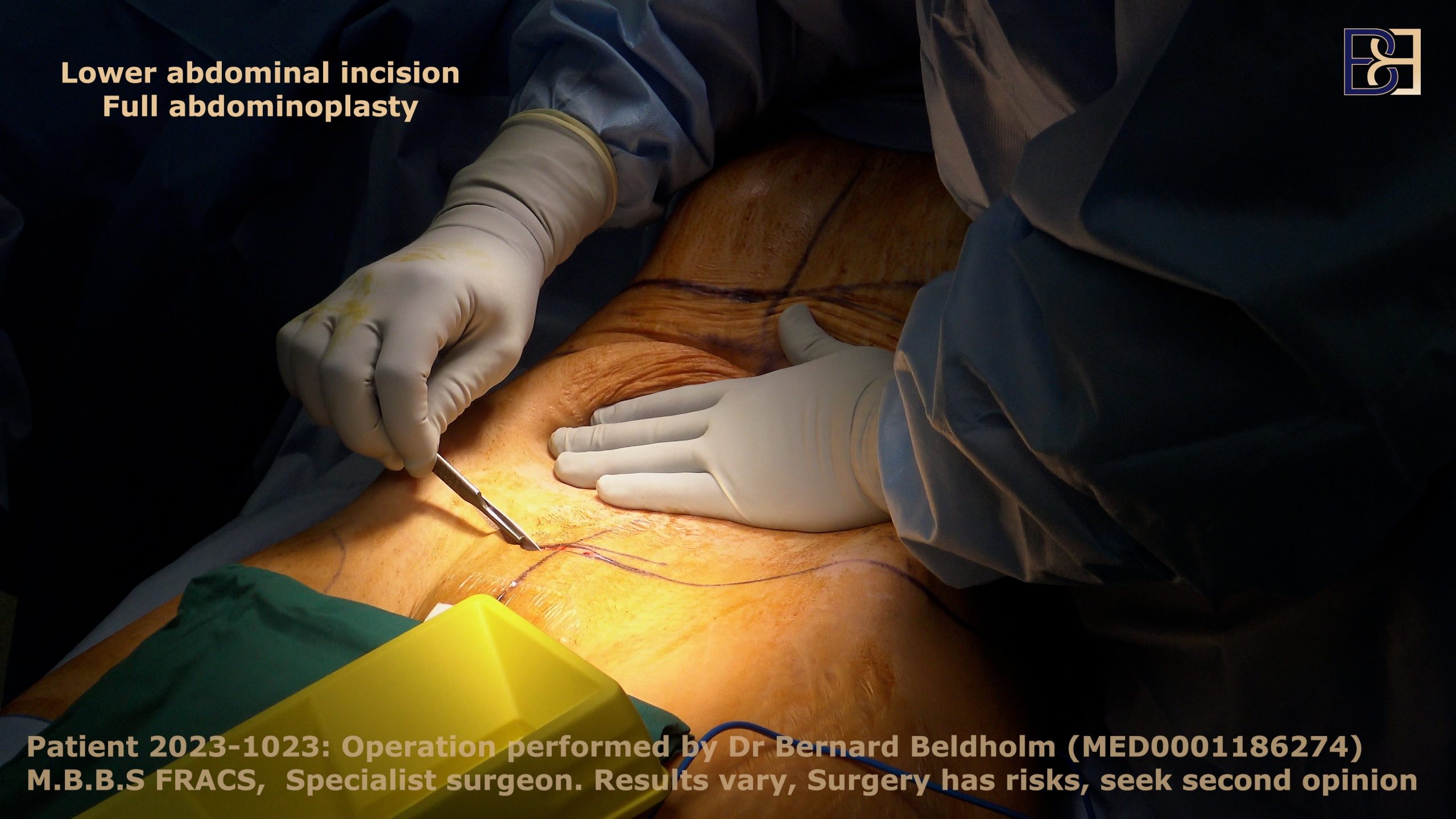 Initial lower abdominal incision made | Dr Bernard Beldholm