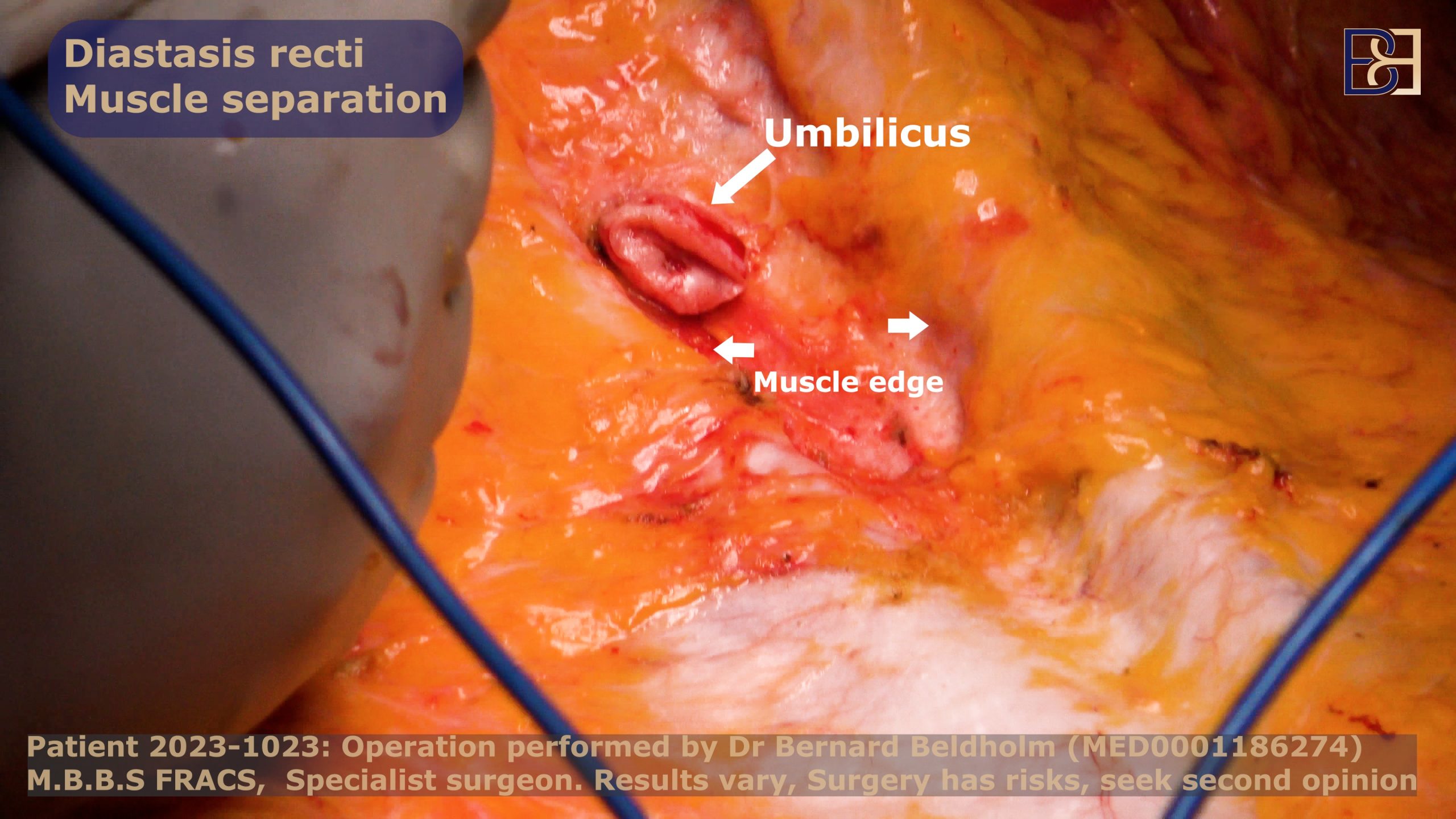 diastasis recti in one of Dr Bernard Beldholm's patients