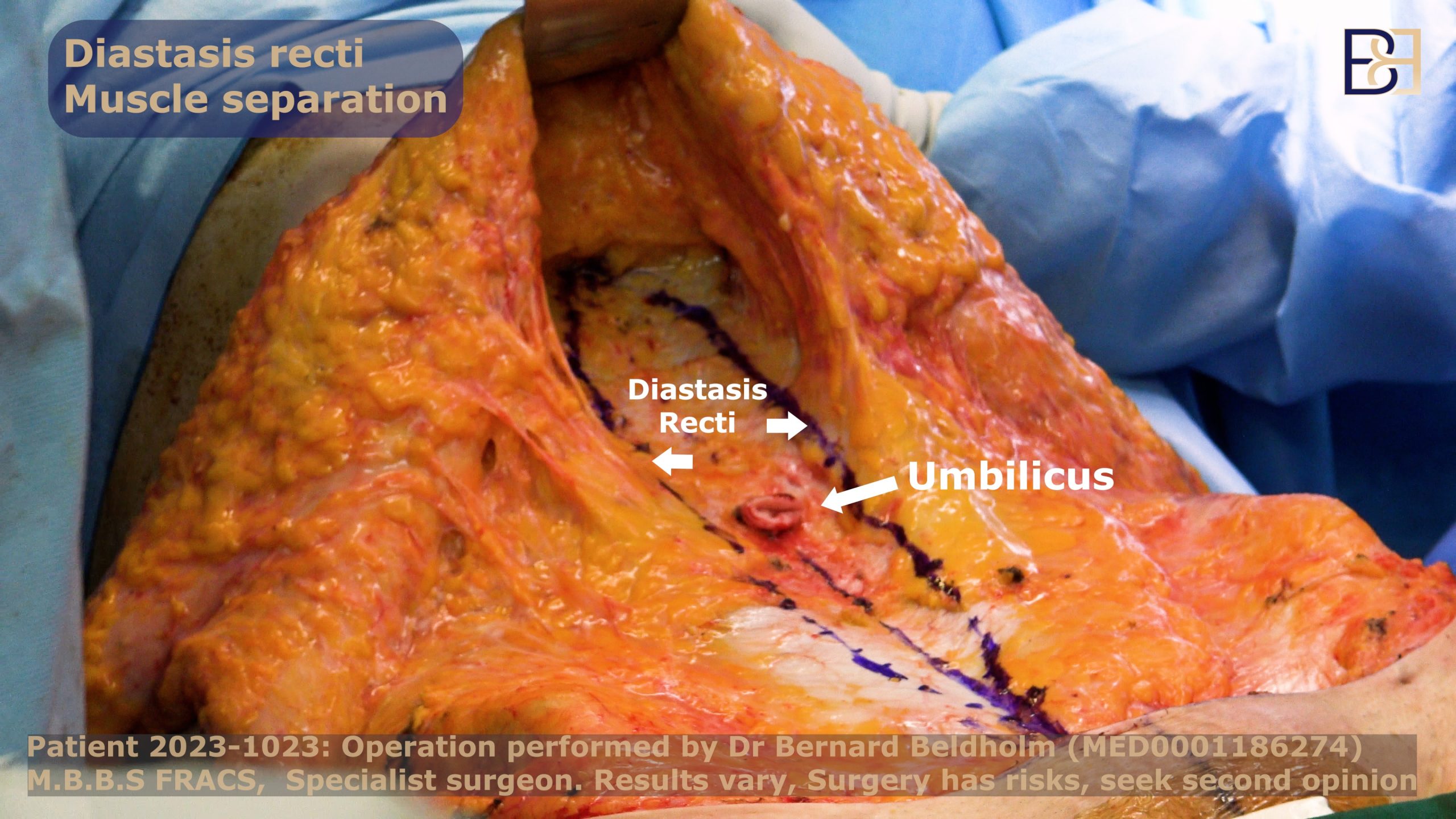 Lower abdominal skin lifted exposing the diastasis recti | Dr Bernard Beldholm