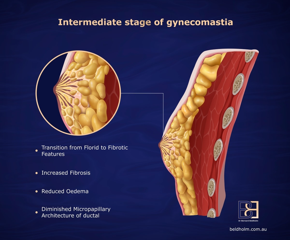 Intermediate stage of gynaecomastia | Dr Beldholm