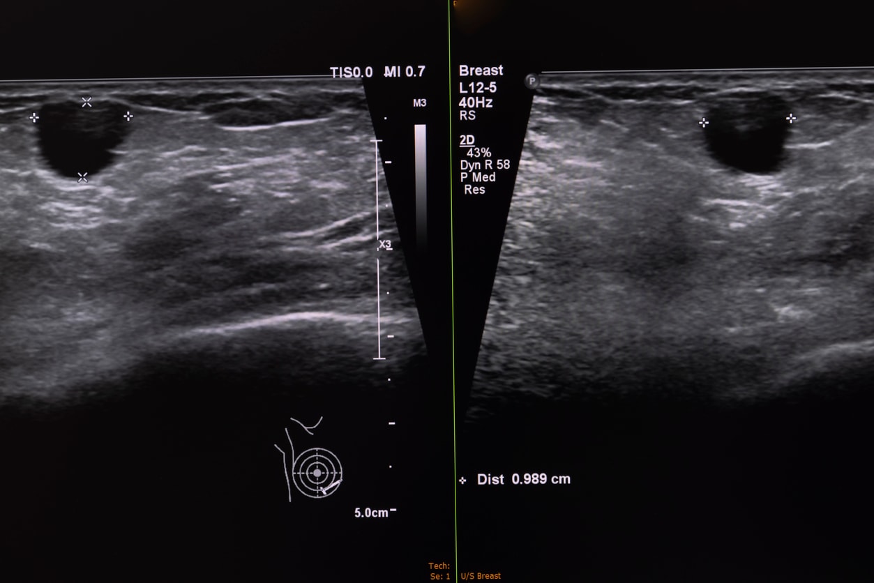 Breast Ultrasound