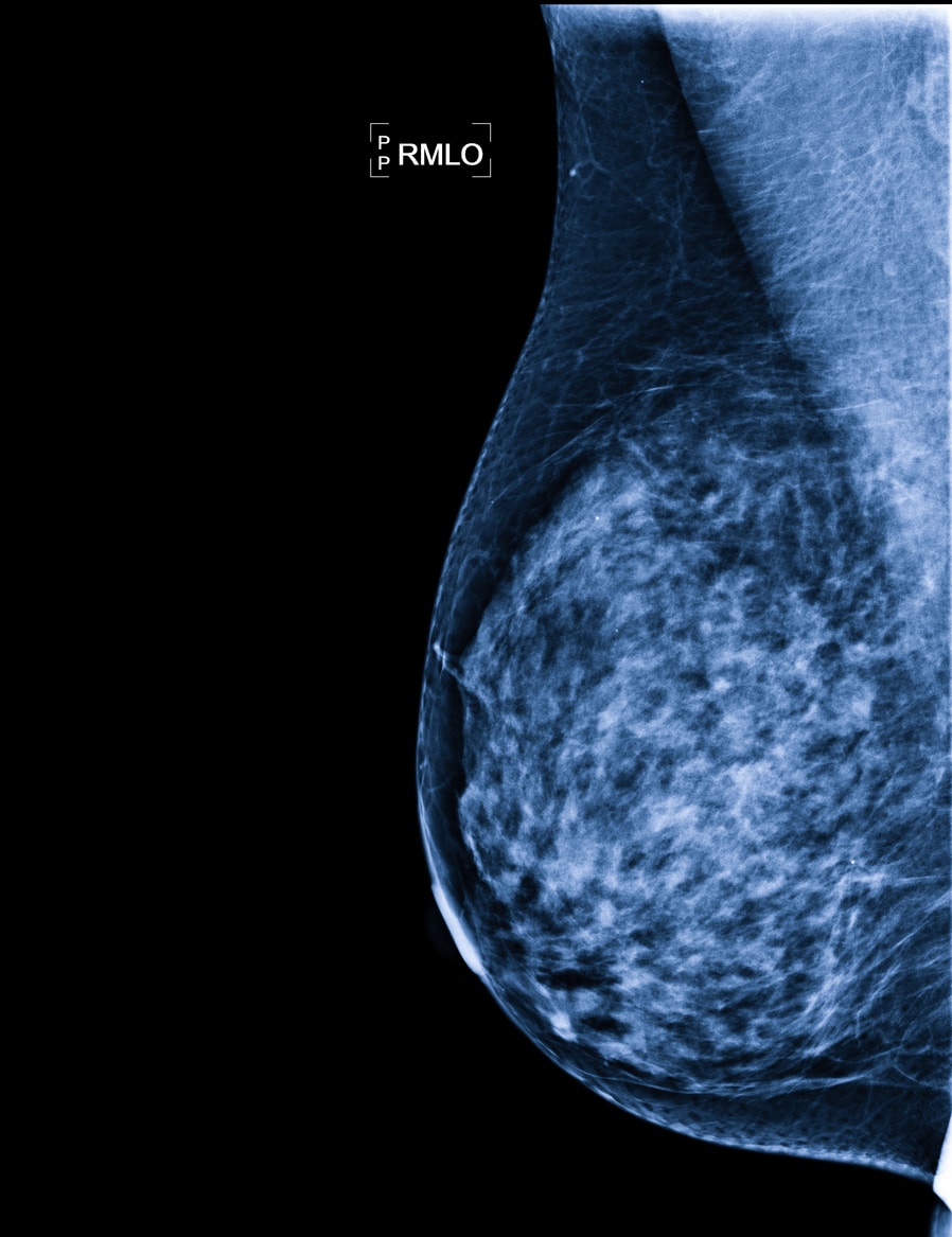 Illustration of imaging patterns in gynecomastia.