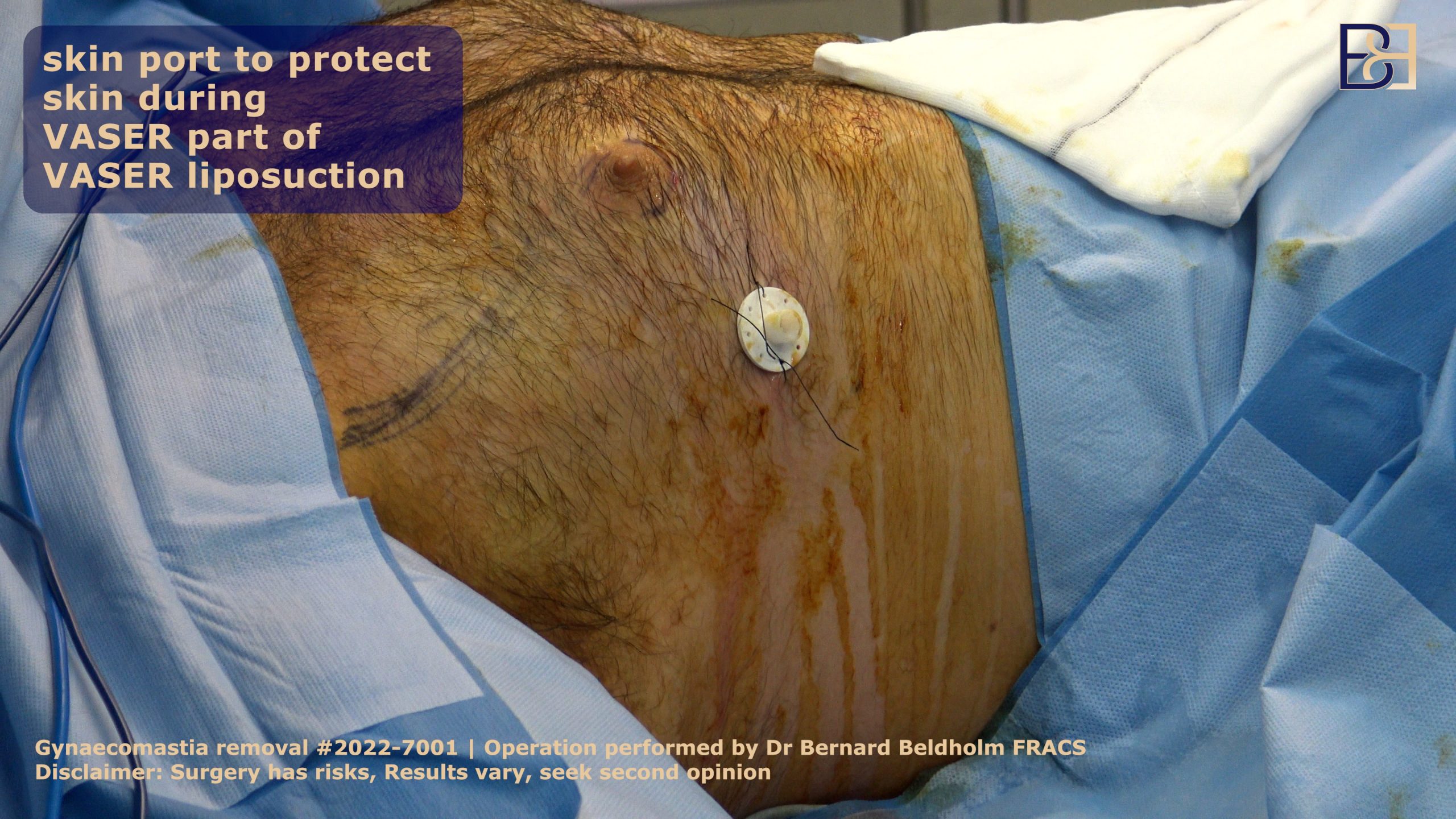 Skin port for VASER liposuction | Dr Beldholm