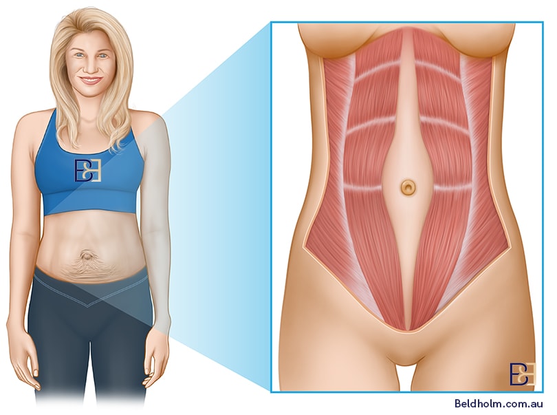 An illustration depicting the concept of diastasis recti, showing the separation of abdominal muscles.