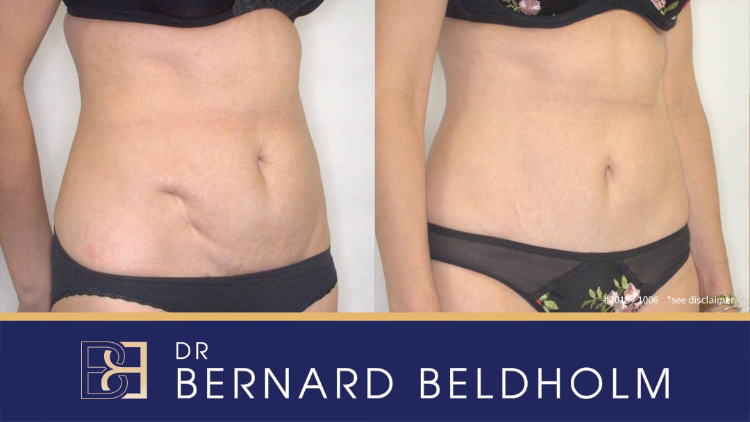 Mini-abdominoplasty done by Dr Beldholm