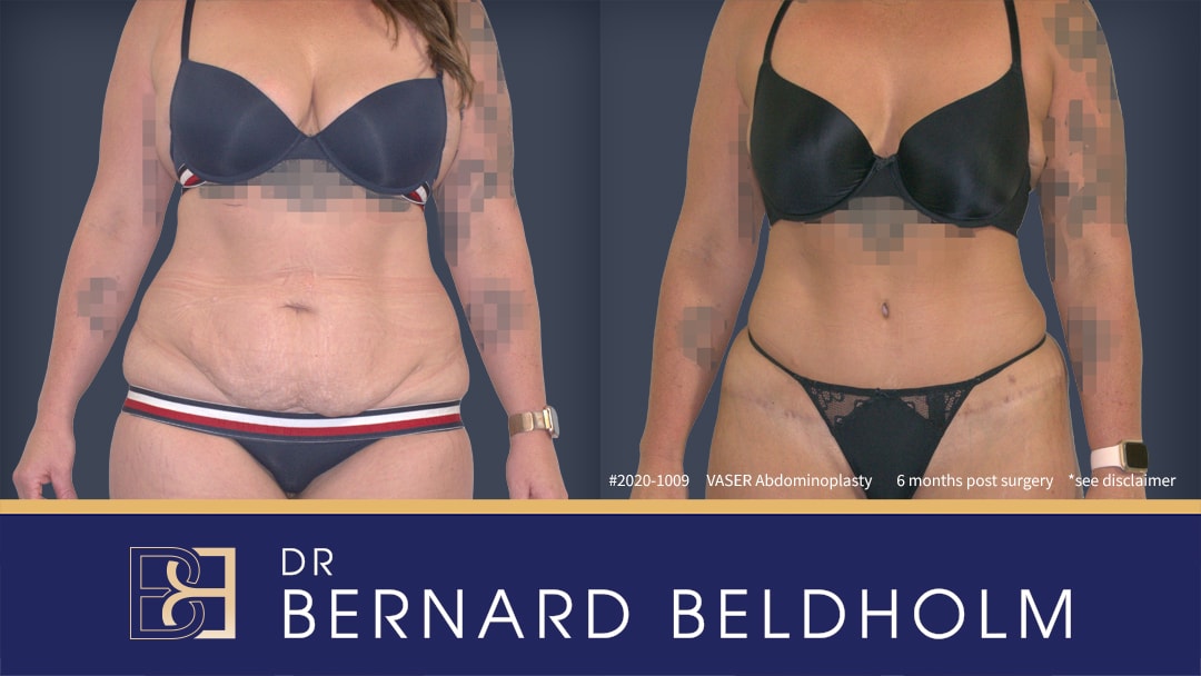 Full abdominoplasty done by Dr Beldholm