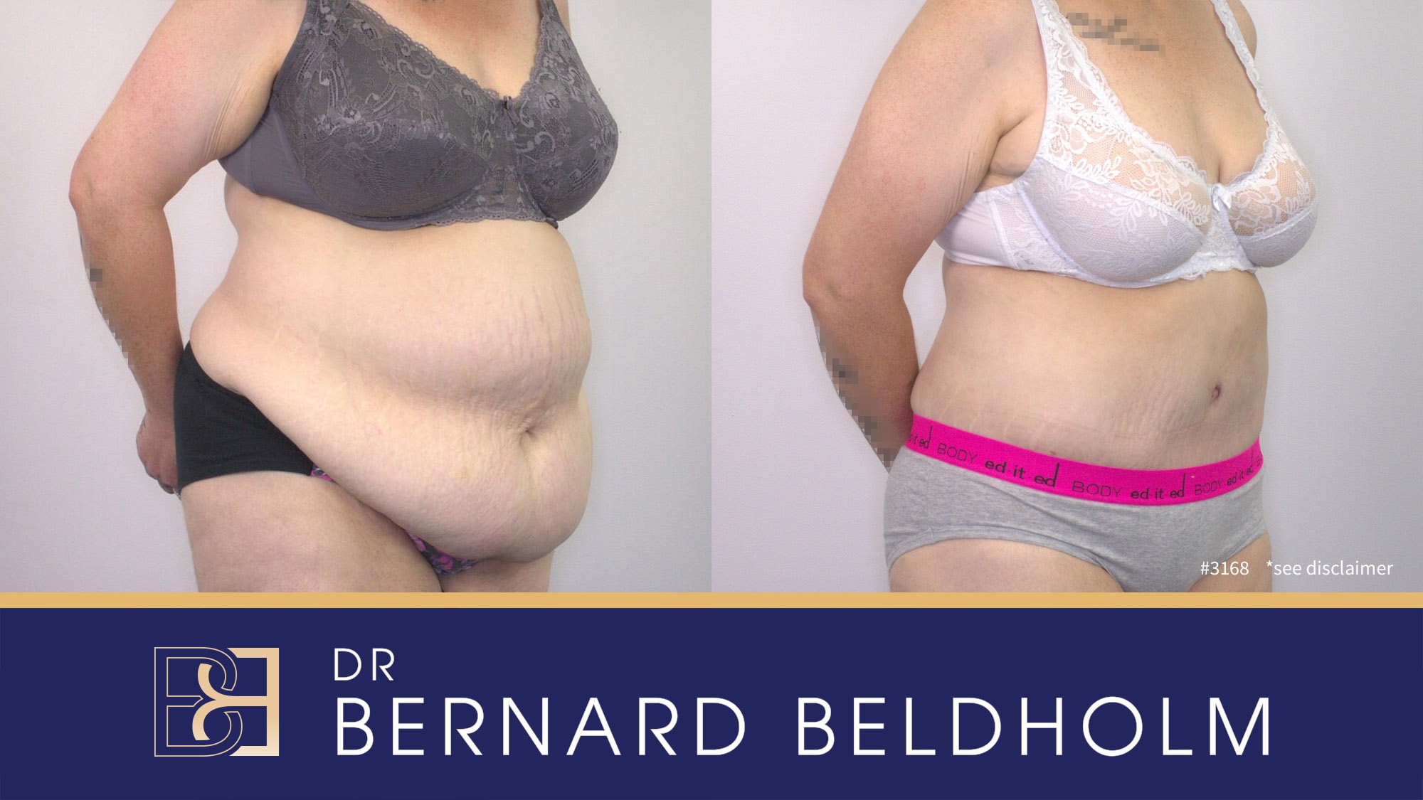 Extended Abdominoplasty performed by Dr Beldholm for post pregnancy changes