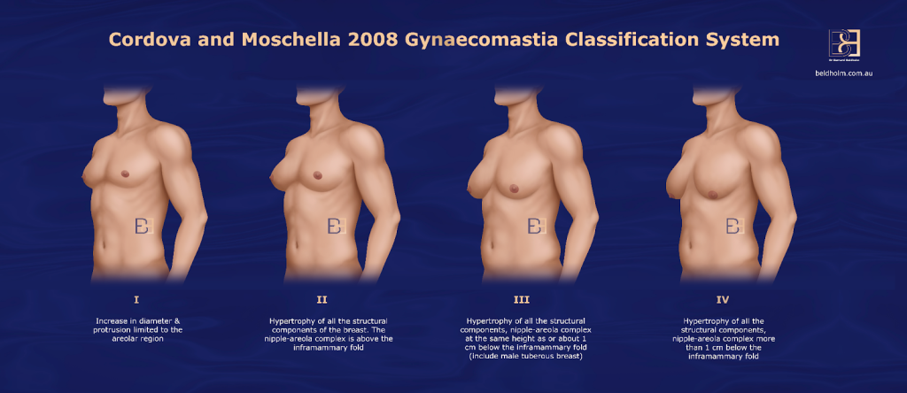 Cordova and Moschella 2008 Gynecomastia Classification System