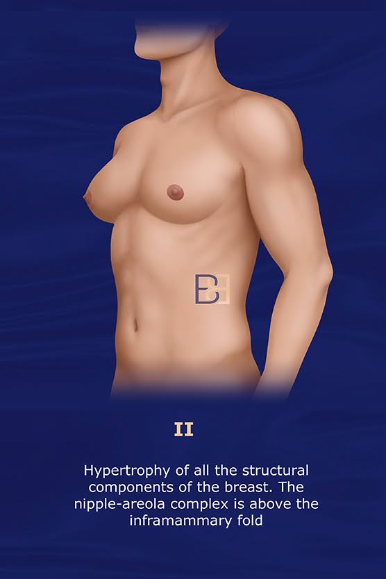 Cordova and Moschella Gynecomastia Grading System Grade II