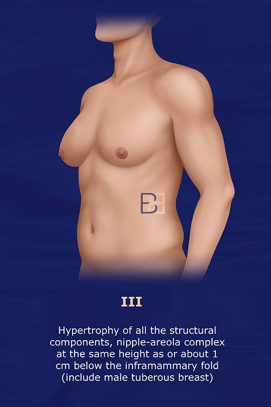 Cordova and Moschella Gynecomastia Grading System Grade III