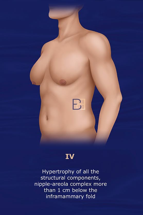 Cordova and Moschella Gynecomastia Grading System Grade IV