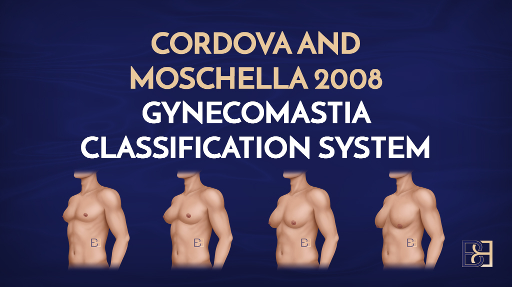 Cordova and Moschella 2008 Gynecomastia Classification System