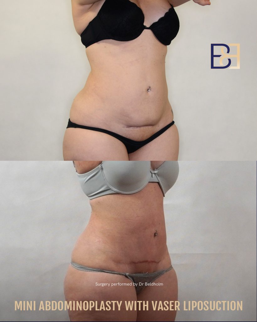 DrBB IG image Patient 2022 1019 Mini Abdominoplasty with VASER 2