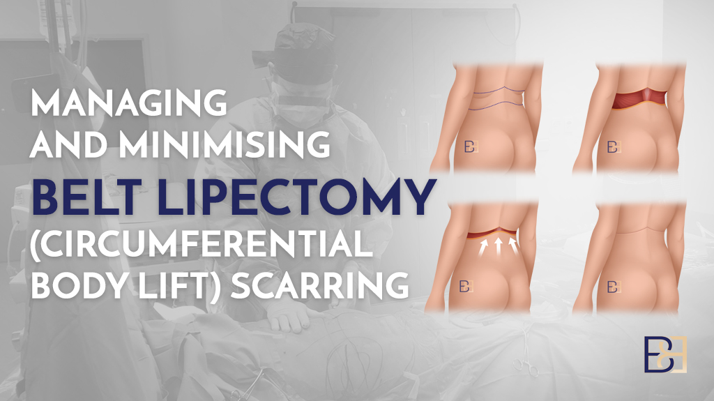 Managing and Minimising Belt Lipectomy Scarring (Circumferential Body Lift Scars)