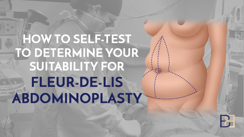 Self-Testing to Determine Whether You’re a Candidate for Fleur-de-Lis Abdominoplasty
