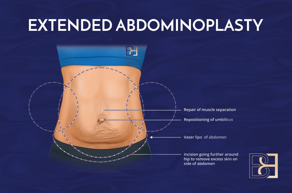 Extended abdominoplasty Video