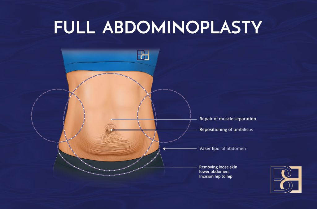 FULL abdominoplasty Video