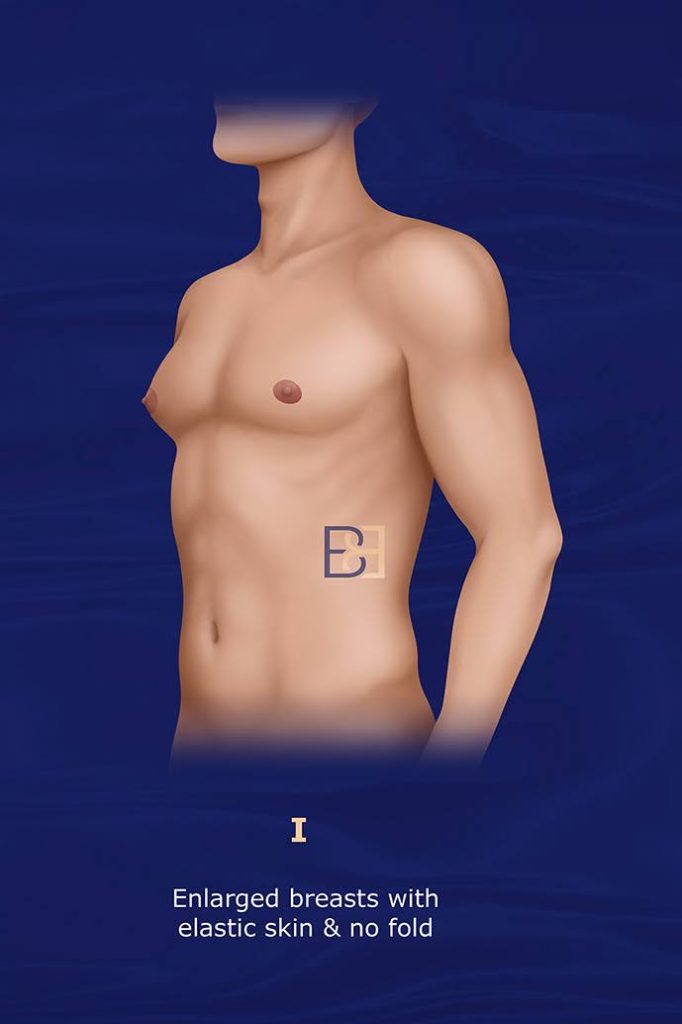 Grade I Minor Gynecomastia