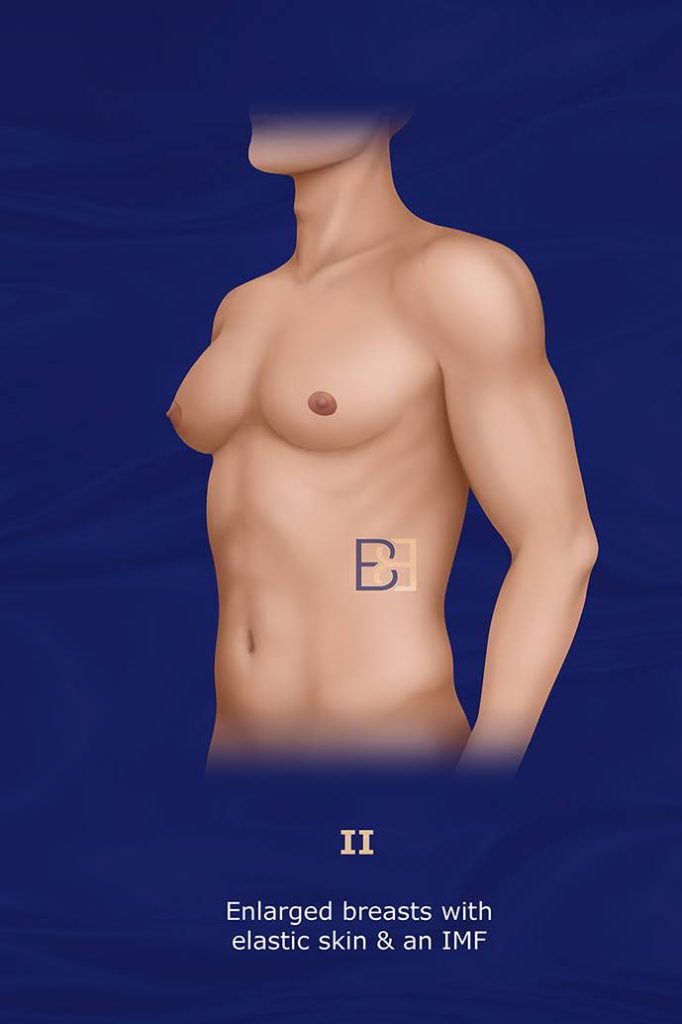 Grade II Moderate Gynecomastia