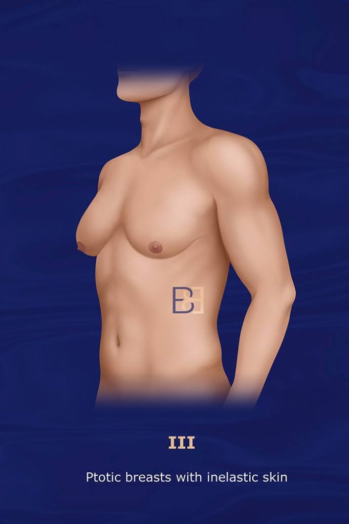 Grade III Severe Gynecomastia