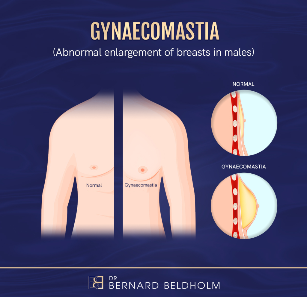 Gynaecomastia - Abnomal Enlargement of Breasts in Males