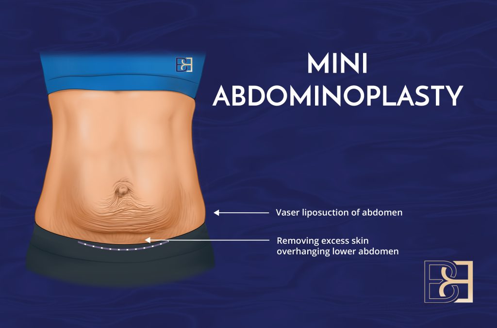 Mini abdominoplasty Video