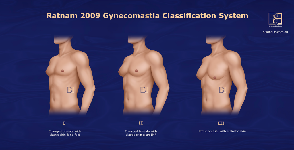 Ratnam 2009 Gynaecomastia Classification System