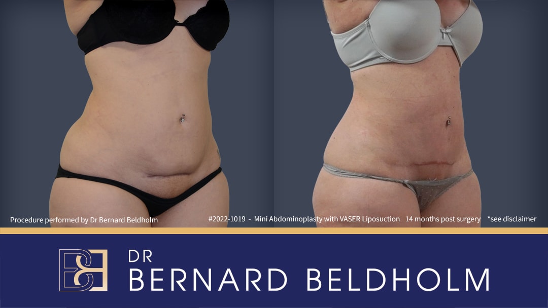 Mini abdominoplasty by Dr Beldholm