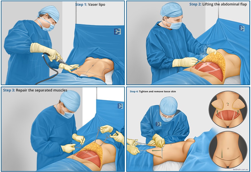 An illustration showing the concept of abdominoplasty, including the abdominal area and surgical tools | Dr Beldholm