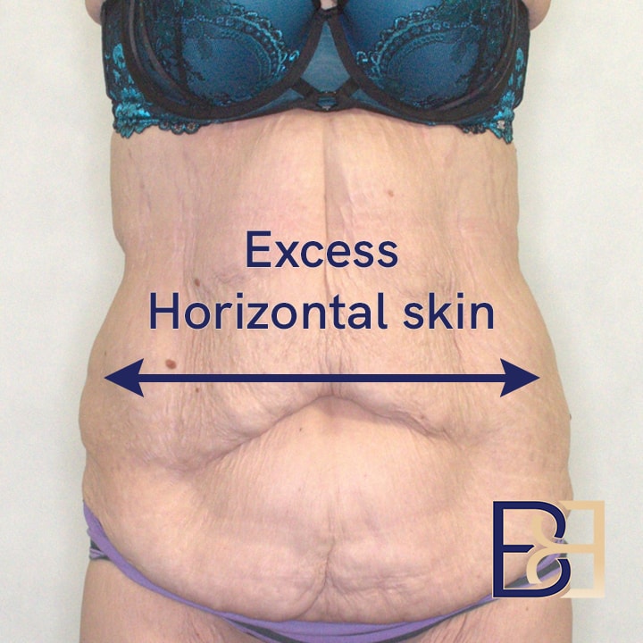 Excess horizontal skin | Dr Beldholm